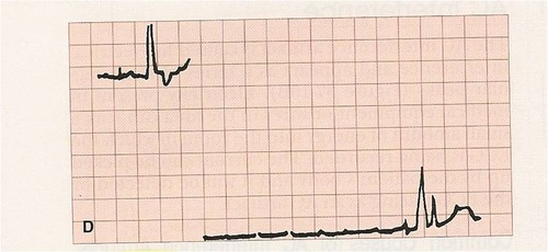 <ul><li><p>obvious break in the tracing</p></li><li><p>usually related to a disconnected or broken lead wire</p></li></ul><p></p>