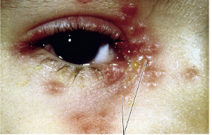 <p>Shingles</p>