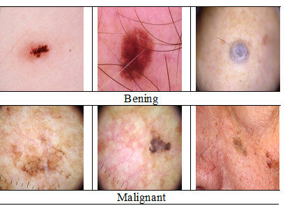 <p>A tumor that has functional cells and are therefore classified as noncancerous</p>