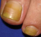 <p>lymphoedema</p>