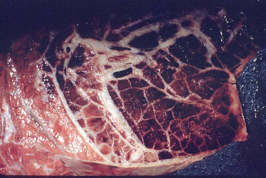 <p>What is the main pathogenic mechanism of this disease? </p>