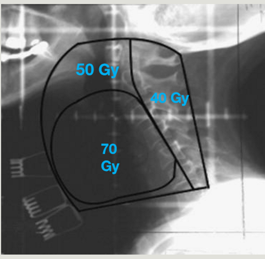 <p>sup = extends along mandible (to include jugulodigastric and middle jugular LN’s if advanced dx)</p><p>inf = inf of cricoid cartilage</p><p>ant = clear skin surface/flash</p><p>post = spinal accessory chain / spinous process</p>