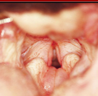 <ul><li><p><span style="color: rgb(136, 136, 136)"><strong>Et: </strong></span><span style="color: red"><strong>Stenotic nares, Elongated soft palate, Everted laryngeal saccules, Laryngeal collapse, Hypoplastic trachea (English bulldog)</strong></span></p><ul><li><p><span style="color: red"><strong>Not collapsing trachea</strong></span></p></li><li><p><strong><u>Elongated soft palate - Primary malformations</u></strong></p></li></ul></li></ul><ul><li><p><span style="color: rgb(136, 136, 136)"><strong>Cs: Signs of upper airway obstruction-</strong> </span>Inspiratory issues, cough, <u>vocal change, stertor/stridor,</u> exercise intolerance, cyanosis, syncope</p></li></ul><ul><li><p><span style="color: rgb(136, 136, 136)"><strong>Dt: </strong></span>PE, scope, rads</p></li><li><p><span style="color: rgb(136, 136, 136)"><strong>Tx:</strong></span><strong> medical management:</strong> rest, keep cool, corticosteroids, <strong>Sx,</strong> tracheostomy: last case/ not recommended</p></li></ul><img src="https://knowt-user-attachments.s3.amazonaws.com/f7dffa50-deaa-4ce4-8b30-4d2bfc193453.png" data-width="25%" data-align="center"><img src="https://knowt-user-attachments.s3.amazonaws.com/c2ba3c75-f4c2-45c7-b59d-2b8122f291bc.png" data-width="50%" data-align="center"><p></p>
