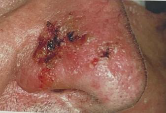 <ul><li><p>Identify the disease</p></li><li><p>Clinical Feature</p></li><li><p>Course of pemphigus vulgaris is variable</p></li></ul><p></p>