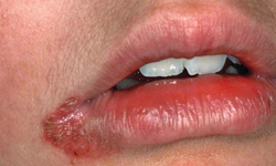 <p>Cheilosis (swelling and fissuring of the lips)</p>
