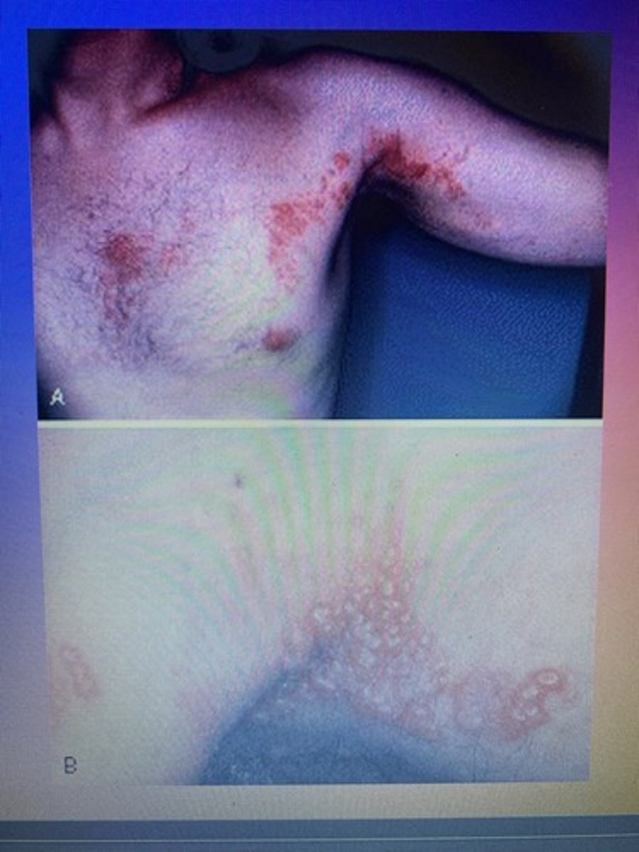 <p>This unilateral cluster of vesicles on along the patients peripheral nerve.</p>