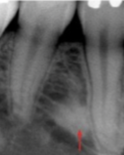 <p>What is this lesion? </p>