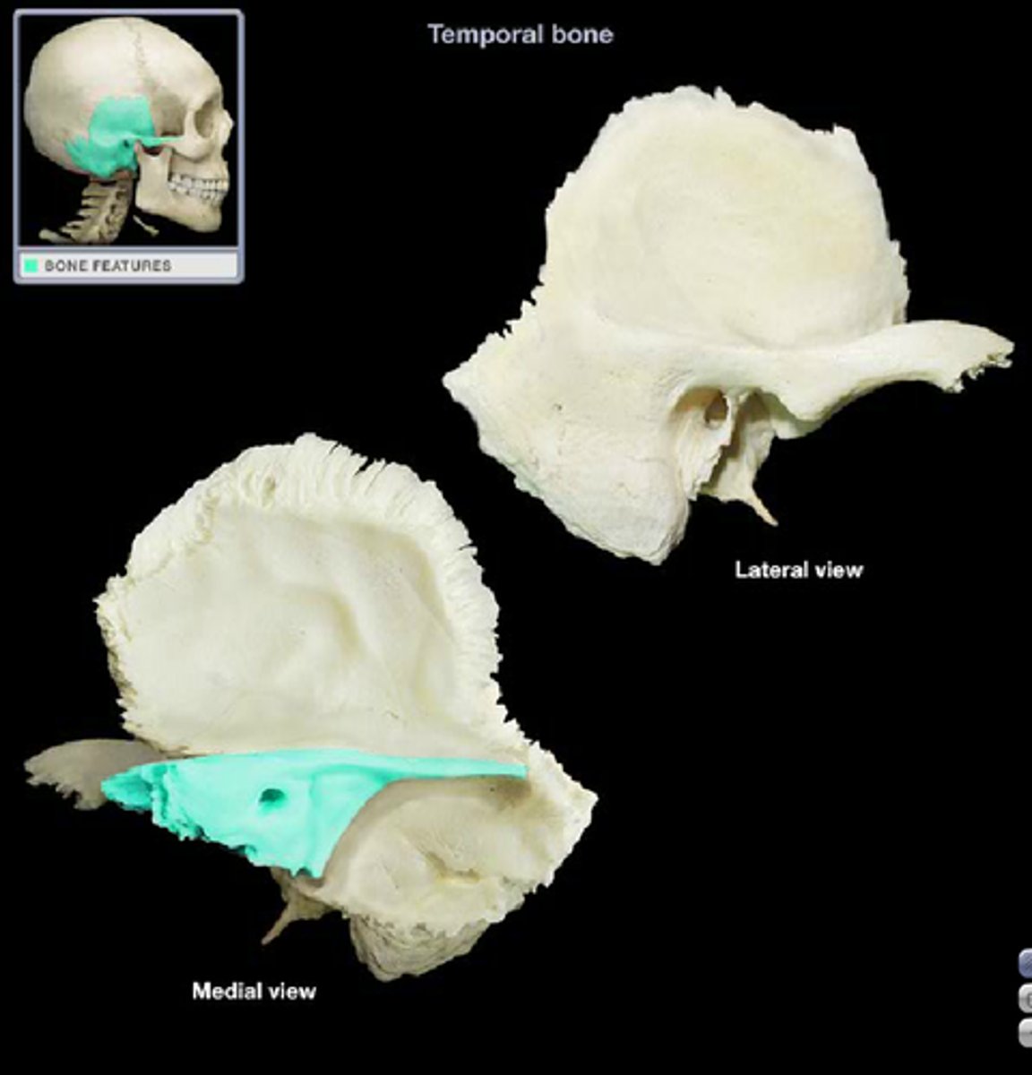 <p>Includes the internal acoustic meatus/internal auditory canal</p>