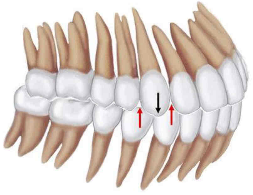 <p>class l occlusion</p>