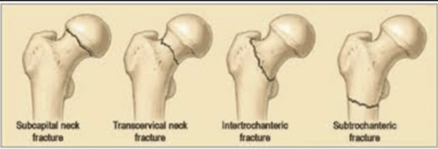 <p>fracture line through femoral head-neck junction;</p><p>high risk of necrosis in femoral head</p>