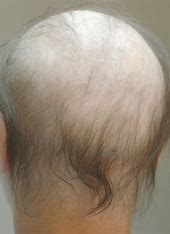 <p>patchy, asymmetric loss of hair caused by chemotherapy or radiation.</p><ul><li><p>growing hairs are lost and resting hairs are spared.</p></li><li><p>regrowth occurs after chemotherapy is stopped.</p></li></ul>