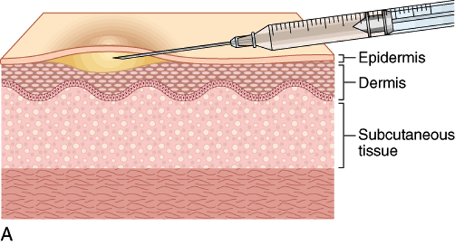 <p>intradermal injection used to assist in diagnosing various infectious diseases</p><p>ex: TB</p>
