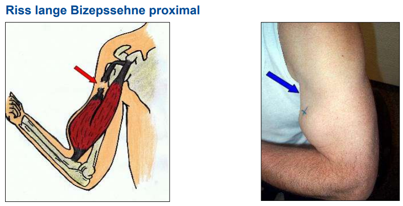<ul><li><p>Muskelbauch rutscht nach unten</p></li><li><p>auswirkung 10% auf Kraft</p></li><li><p>nicht unbedingt zu versorgen</p></li></ul><p></p>