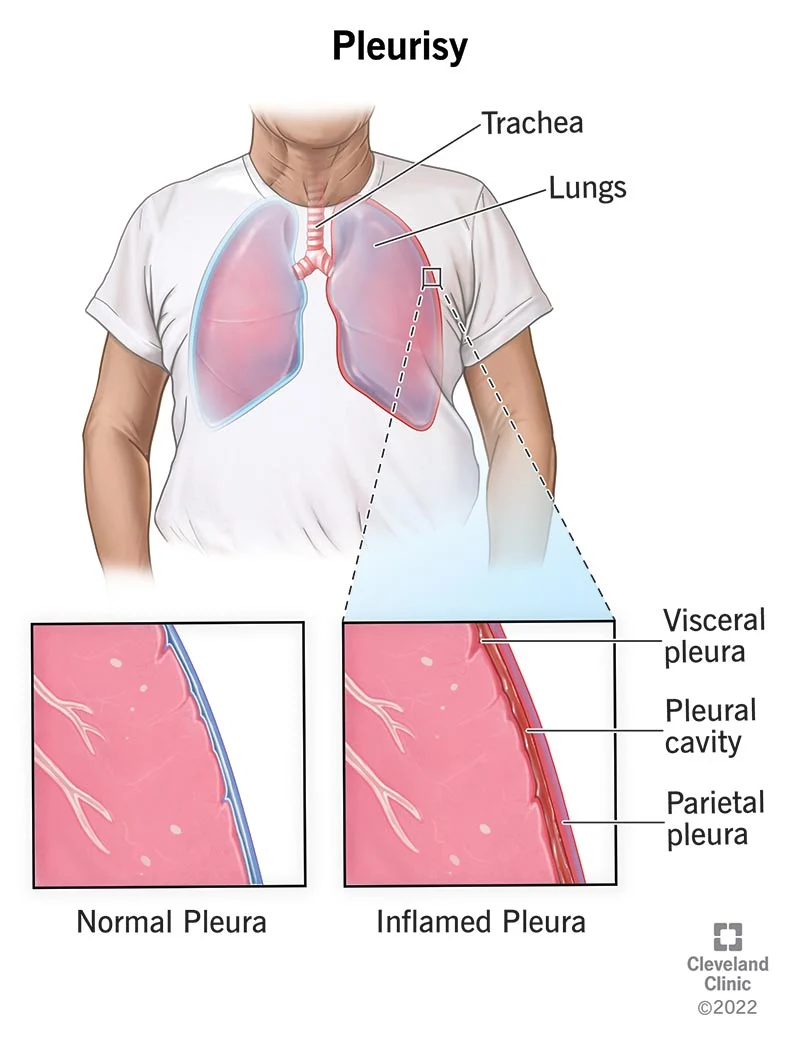 <p>Define pleuritic chest pain/inflammation</p>