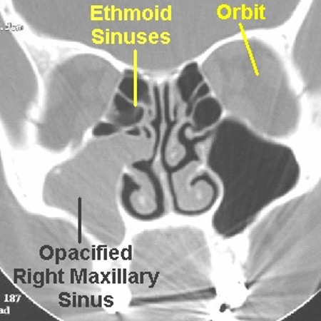 <p>sinus mucosa chronically inflamed, persistent low grade infection with periodic flare ups, sx persist longer than 3 months, repeated sinus infections (&gt;3x in 6 months)</p>