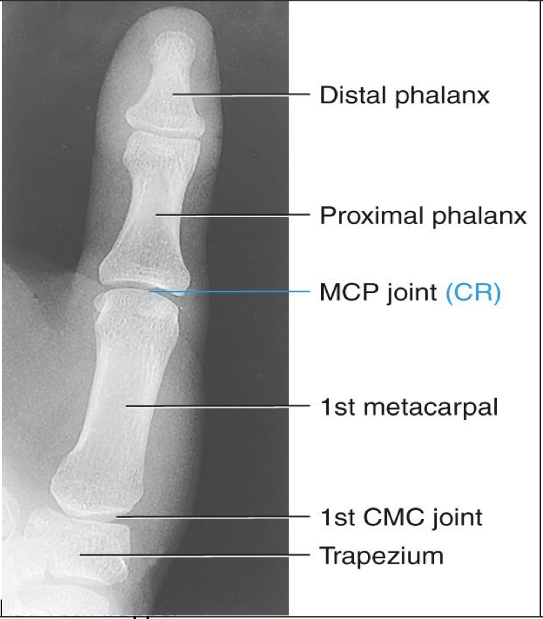 <p><span style="line-height: normal;">• </span>Entire thumb demonstrated (including first CMC joint)</p><p class="p1"><span style="line-height: normal;">• </span>No soft tissue overlapping MCP</p><p class="p1"><span style="line-height: normal;">• </span>Center field at first MCP joint</p><p class="p1"><span style="line-height: normal;">• </span>Must include trapezium</p><p class="p1"><span style="line-height: normal;">• </span>No rotation of phalanges</p><p class="p1"><span style="line-height: normal;">• </span>Equal concavity and soft tissue</p>