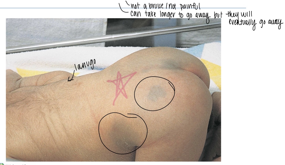 <p>Bruise like spots </p>