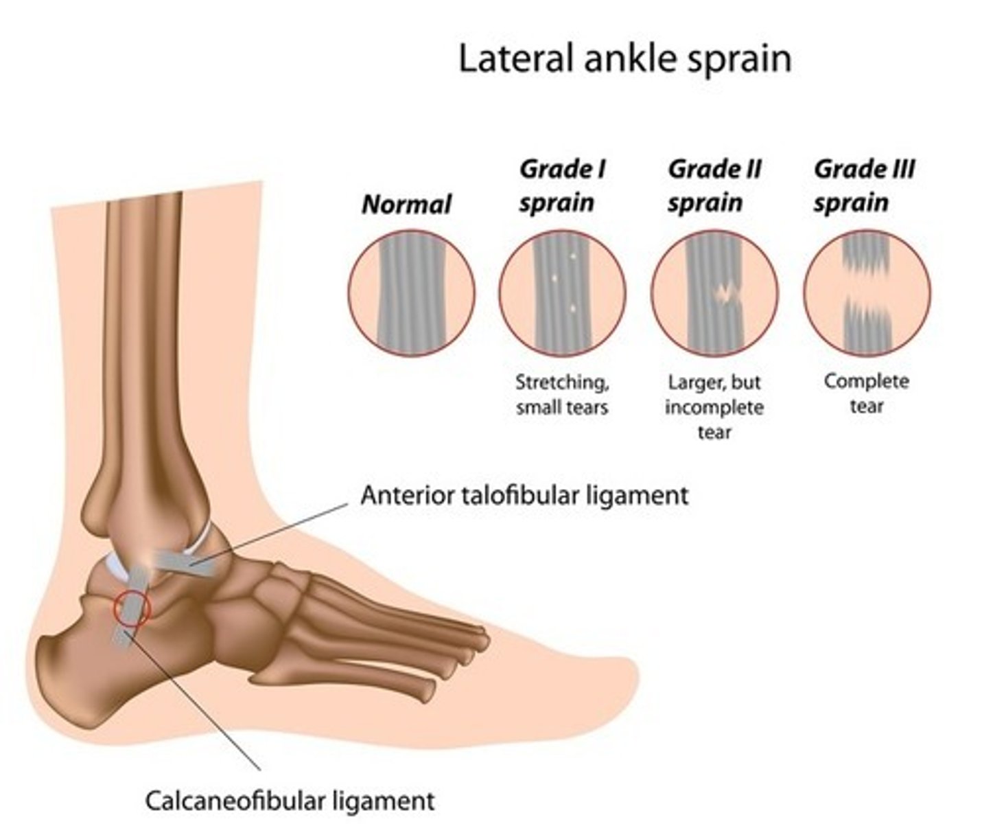 <p>Complete tearing of ligament in association with swelling; gap may be present between tear</p>
