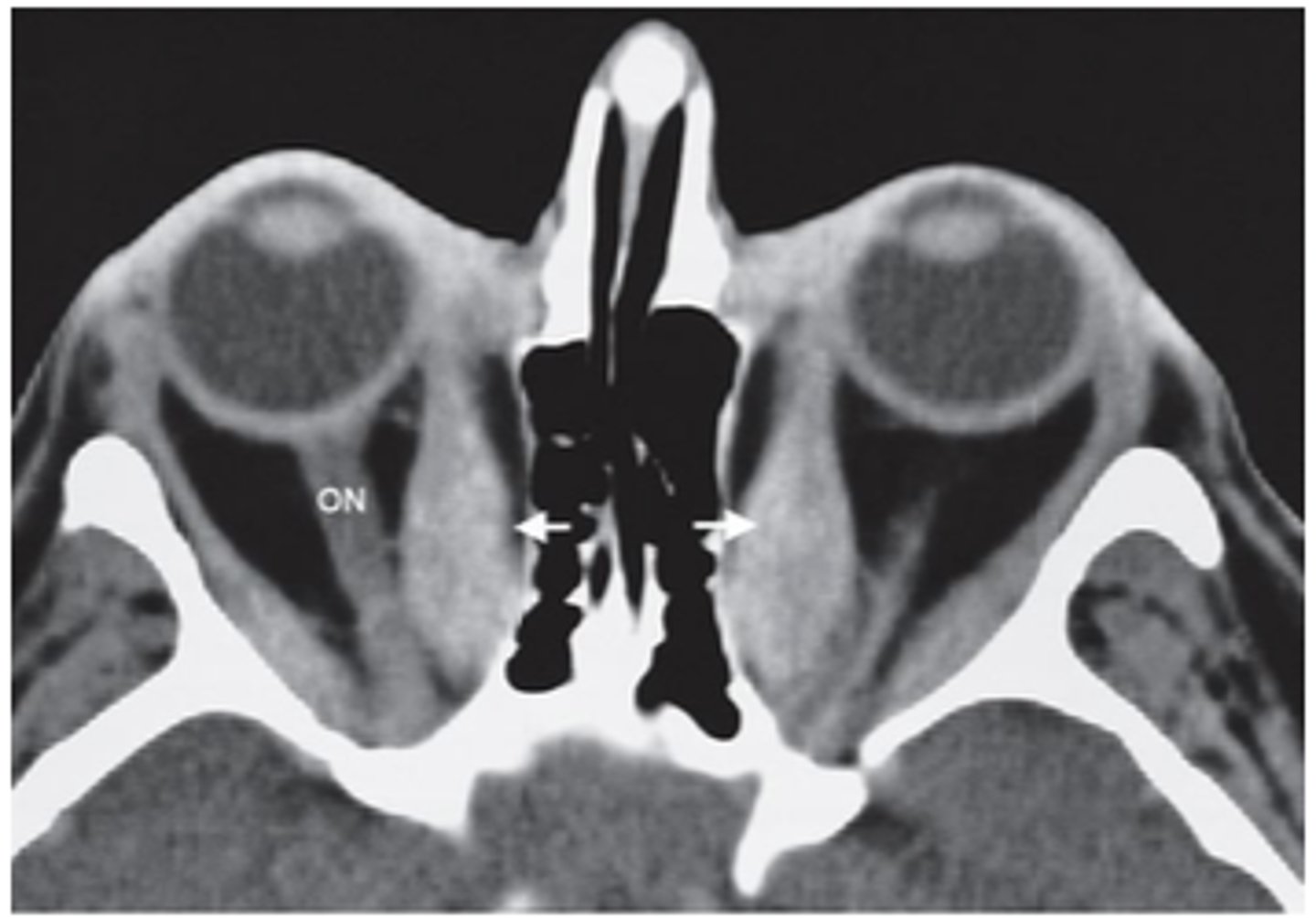 <p>compression of the optic nerve in the apex</p><p>of the orbit</p>