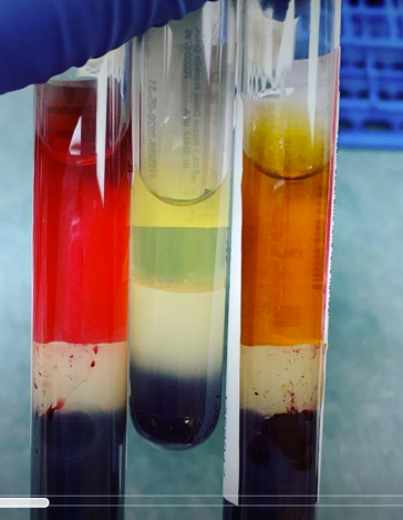 <p><span><u>Hemolysis </u>= damage to RBC membranes causing release of RBC contents into plasma (hemoglobin/electrolytes) </span></p><ul><li><p class="Paragraph SCXW78408044 BCX0" style="text-align: left;"><span>Presence of hemoglobin makes serum red/pinkish, but still clear in opacity </span></p></li></ul><ul><li><p class="Paragraph SCXW78408044 BCX0" style="text-align: left;"><span>NOT IDEAL FOR TESTING because it affects the reliability and validity of the results (false positive/negative)</span></p></li></ul><p class="Paragraph SCXW78408044 BCX0" style="text-align: left;">normal color = clear or yellow</p><p></p>