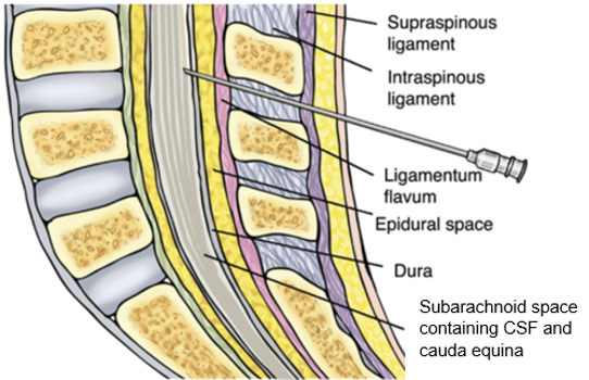 <ul><li><p>skin</p></li><li><p>subcutaneous fat</p></li><li><p>supraspinous ligament</p></li><li><p>interspinous ligament</p></li><li><p>ligamentum flavum</p></li><li><p>epidural space</p></li><li><p>dura mater</p></li><li><p>subdural space </p></li><li><p>arachnoid mater</p></li></ul><p></p><p>the needle then enters the subarachoid space to collect CSF</p><p></p>