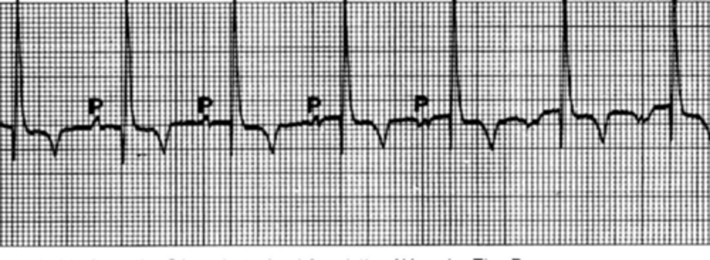 <p>Describe the arrhythmia</p>