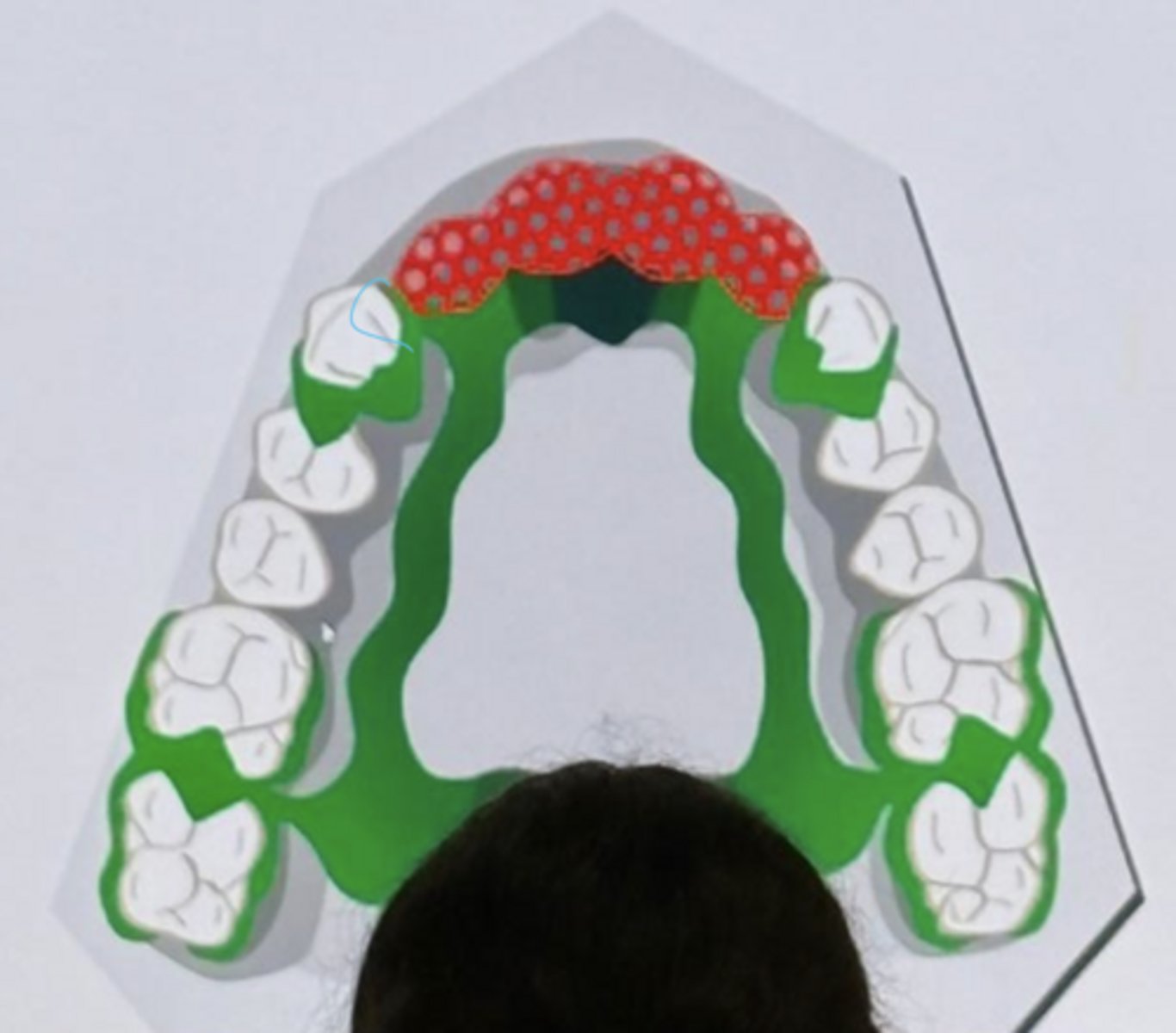<p>-this in a Kennedy Class IV RPD design</p><p>-The major connector is an anterior posterior palatal strap</p><p>-there are 8 abutment teeth</p><p>-The bilateral embrasure rests are providing indirect retention</p>