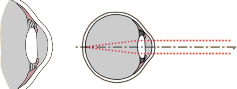 <p>lens under tension (smooth muscle)</p><p>flatter lens → see farther away</p>