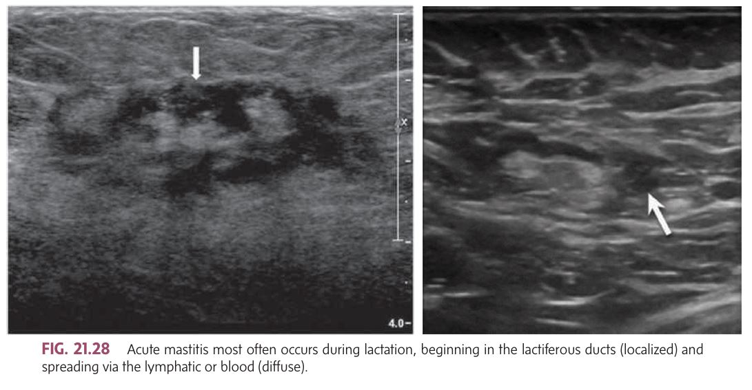 <p><strong>Mastitis</strong>:</p><ul><li><p class=""><strong>Types</strong>:</p><ol><li><p class=""><strong>Puerperal Mastitis</strong> (Most common acute type during lactation).</p></li><li><p class=""><strong>Periductal Mastitis</strong> (Noninfectious, seen in perimenopausal and menopausal women).</p></li><li><p class=""><strong>Granulomatous Mastitis</strong> (Caused by trauma, foreign bodies, infections, or autoimmune disorders).</p></li></ol></li></ul><p><strong>Acute Mastitis</strong>:</p><ul><li><p class=""><strong>Causes</strong>: Infection, trauma, or mechanical obstruction in milk ducts.</p></li><li><p class=""><strong>Symptoms</strong>: Enlarged, reddened, tender breast, often in a localized area.</p></li><li><p class=""><strong><mark data-color="yellow" style="background-color: yellow; color: inherit">Common in lactating women:</mark></strong></p><ul><li><p class="">If the <strong>galactocele</strong> (milk cyst) becomes infected, it can lead to <strong>mastitis</strong> and potentially form an abscess.</p></li><li><p class="">If a galactocele persists, it may turn into a <strong>lipid or oil cyst</strong>.</p></li></ul></li><li><p class=""><strong>Treatment</strong>:</p><ul><li><p class="">Initially <strong>antibiotics</strong>.</p></li><li><p class="">After inflammation decreases, <strong>breast imaging</strong> (mammogram or ultrasound) can rule out inflammatory breast cancer.</p></li></ul></li></ul><p><strong>Chronic Mastitis</strong>:</p><ul><li><p class=""><strong>Cause</strong>: Chronic inflammation of the glandular tissue, often due to <strong>intraductal secretions</strong> forced into periductal connective tissue.</p></li><li><p class=""><strong>Symptoms</strong>: <strong>Nipple discharge</strong>, possible <strong>nipple retraction</strong>, and <strong>subareolar thickening</strong> (no dominant mass).</p></li><li><p class=""><strong>Ultrasound appearance</strong>: Mixed, diffuse echo pattern with sound absorption.</p></li></ul><p></p>