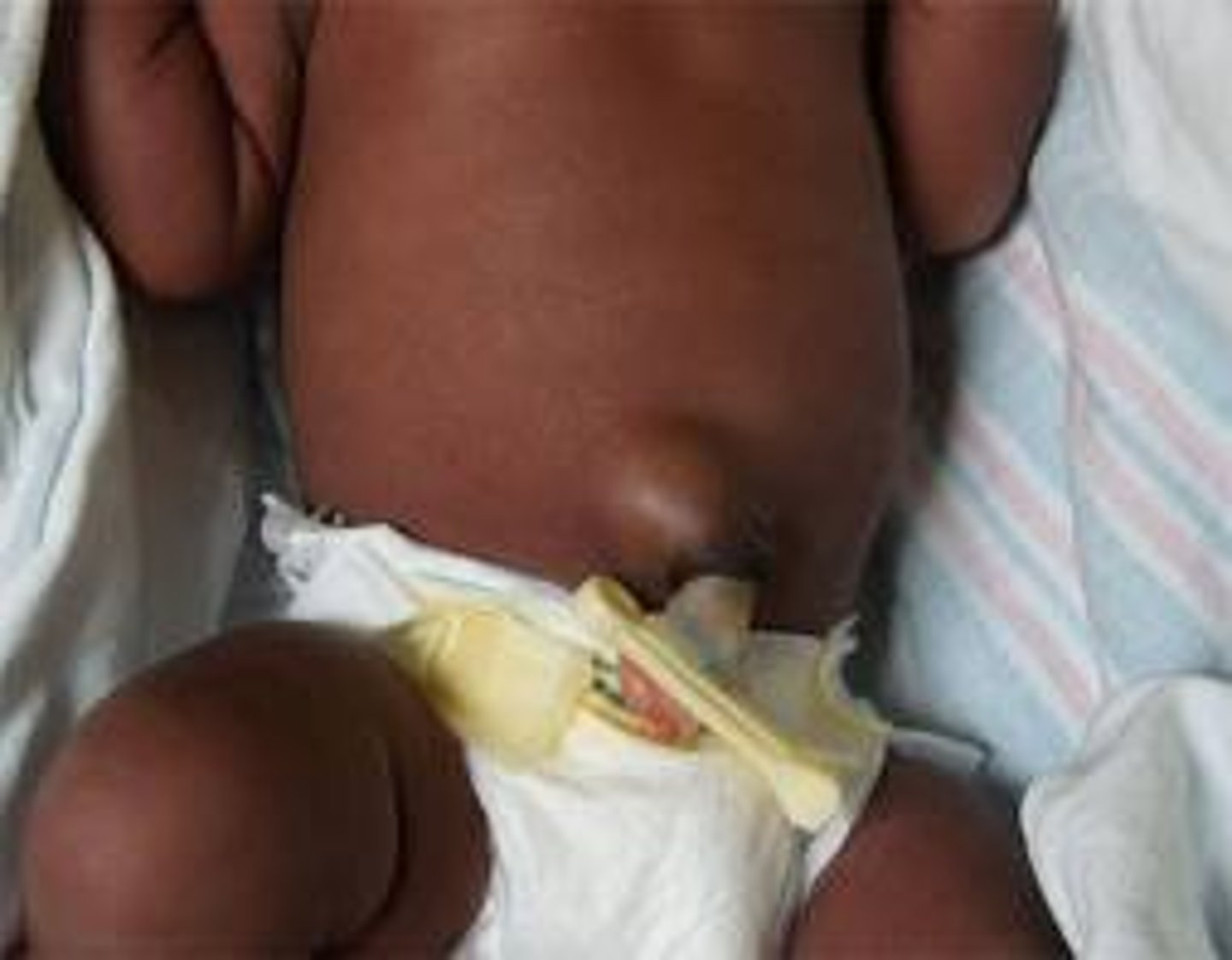 <p>Protrusion of abdominal contents through naval, often due to a congenital defect in the linea alba; soft swelling beneath skin around umbilicus that protrudes during crying or straining</p>