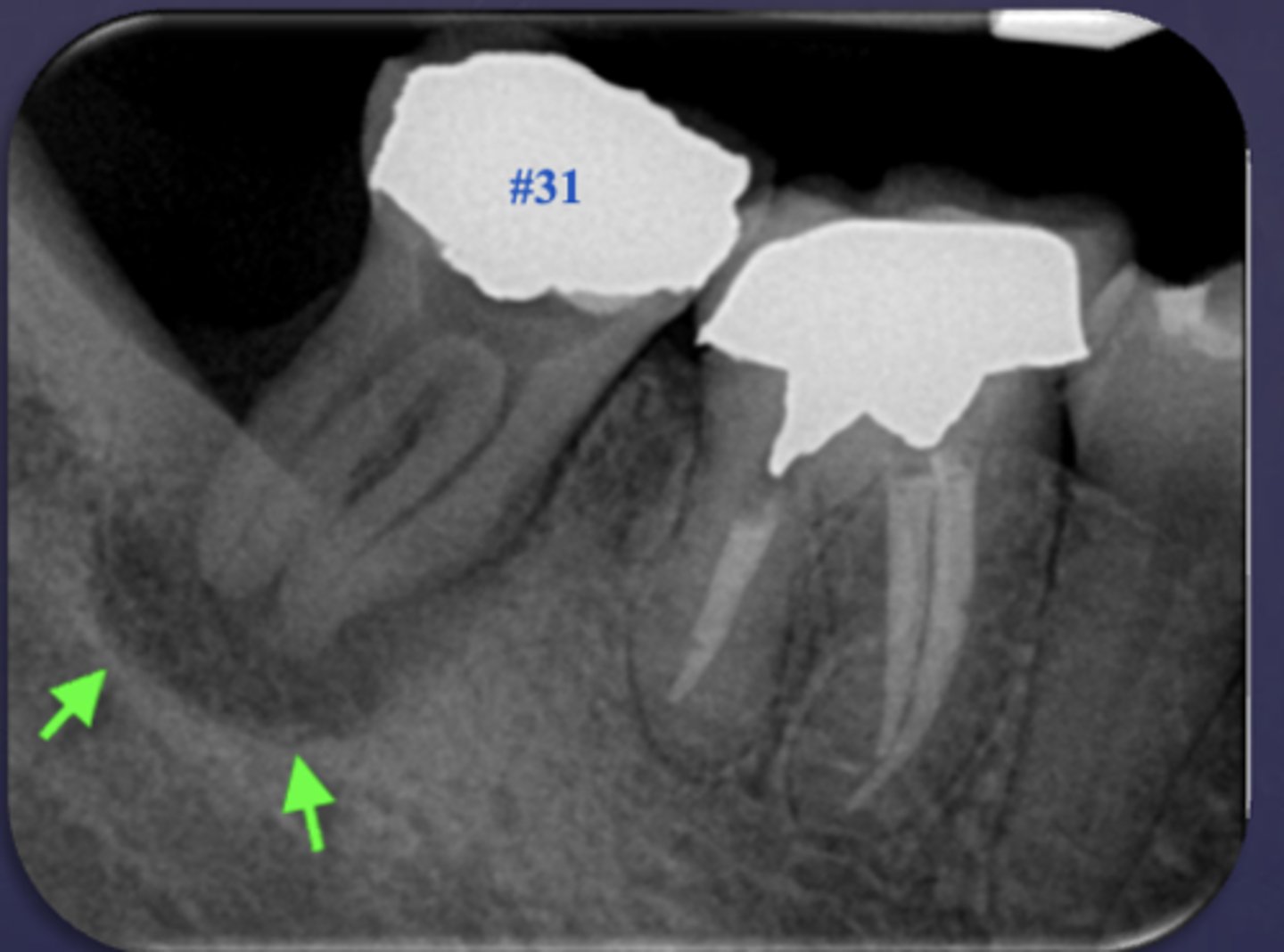 <p>The arrows are pointing at the loss of apical lamina dura and periapical radiolucency, what is the differential diagnosis?</p>