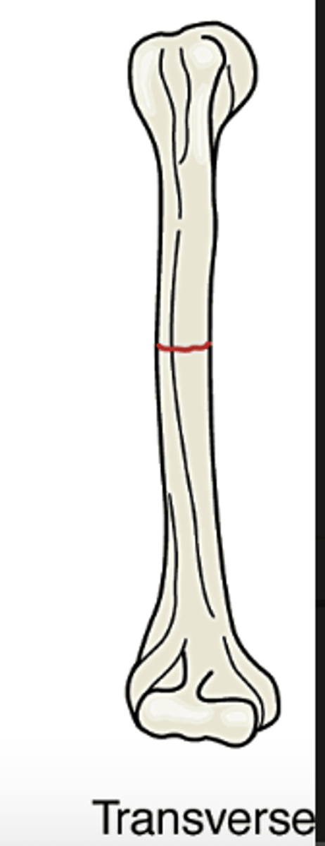 <p>bone is fractured horizontally</p>