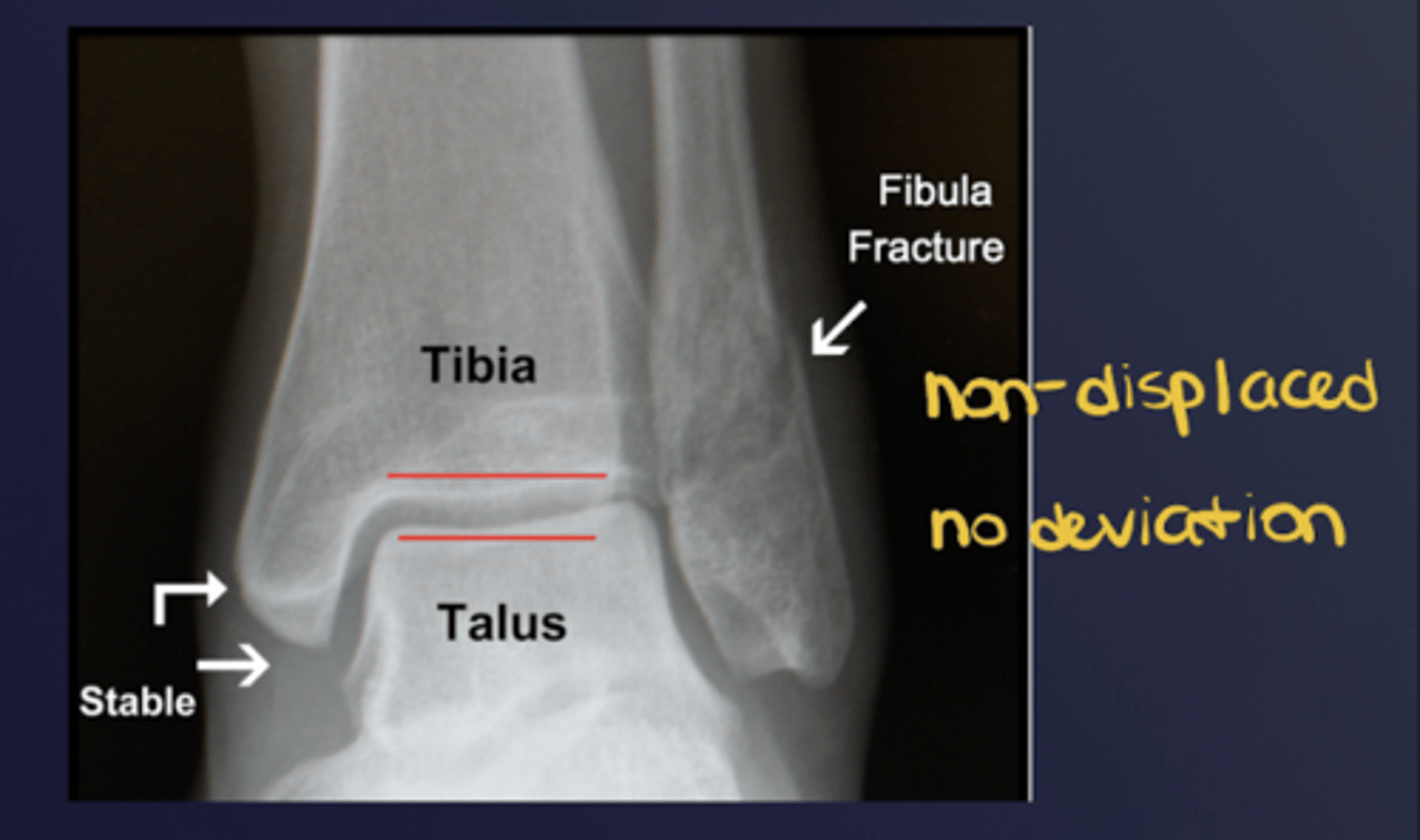 <p>Degree of apposition at osseous ends; abnormality = displacement</p>