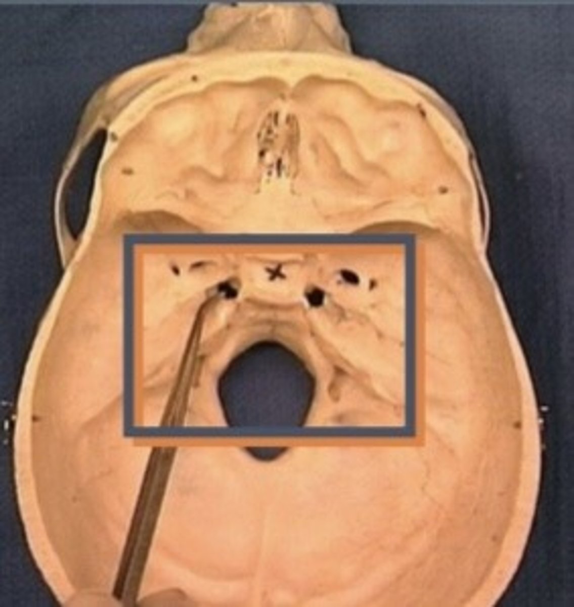 <p>1. Optic foramen</p><p>2. Foramen rotundum</p><p>3. Foramen ovale</p><p>4. Foramen spinosum</p><p>5. Foramen lacerum</p><p>6. Hiatus of facial canal</p>