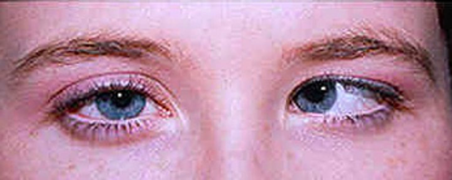 <p>patient presents with the following eye movement. You recognize that this is __________ nerve palsey</p>