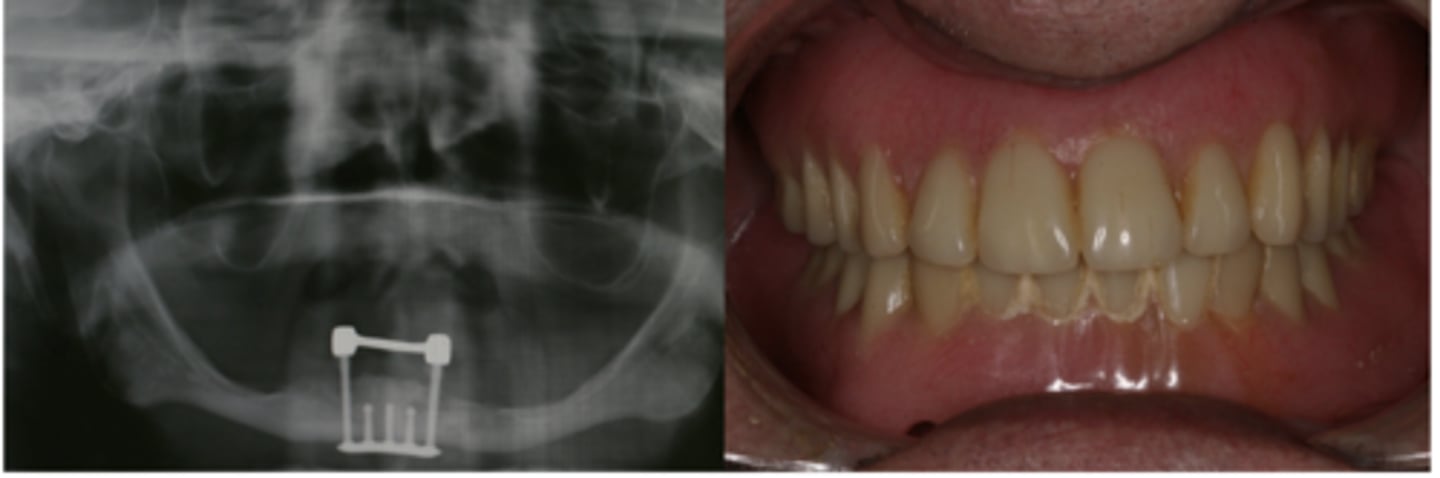 <p>What type of implant?</p>