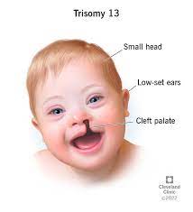 <ul><li><p>low birth weight</p></li><li><p>cutis aplasia</p></li><li><p>cleft lip &amp; palate</p></li><li><p>microphthalmia, anophthalmia, coloboma</p></li><li><p>fused kidneys</p></li></ul>