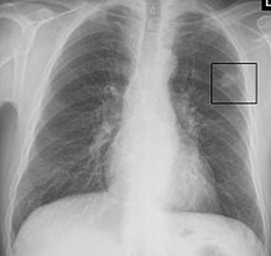 <p>Tumor</p>