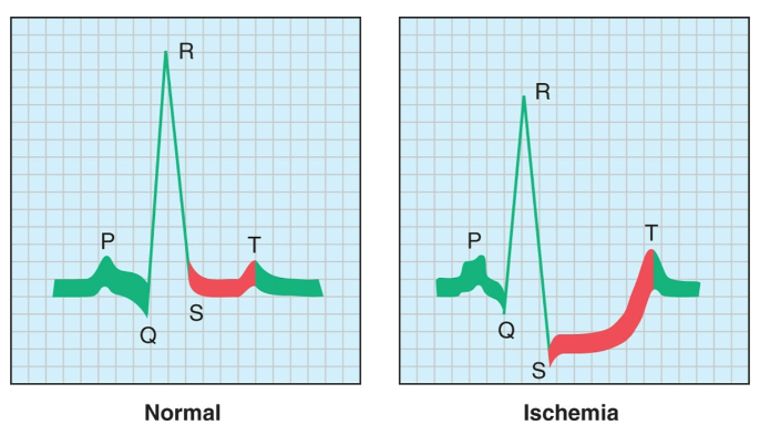 <p>Blockage of the blood vessels leading to/from the heart → causes depression of S-T interval</p><ul><li><p>main cause of damage to heart</p></li><li><p>formation of plaques due to cholesterol build up</p></li></ul>