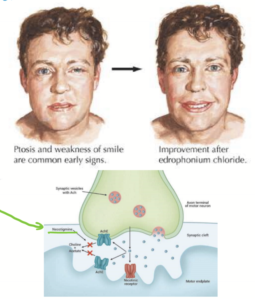 <ul><li><p>Neostigmine (inhibits AChE)</p></li><li><p>Steroids</p></li><li><p>Thymectomy (surgical procedure to remove thymus gland producing T-cells) </p></li></ul><p></p>