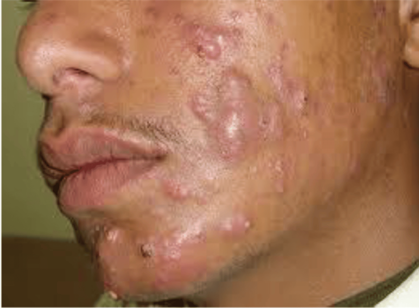 <p>severe nodular form of acne in young males associated with sinus tracts</p>