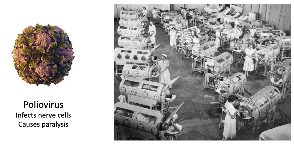<ul><li><p>Poliovirus infects nerve cells → causes paralysis</p><ul><li><p>Early solution: Iron lungs</p></li></ul></li><li><p>Jonas Salk developed the polio vaccine → became very popular</p></li></ul><p></p>