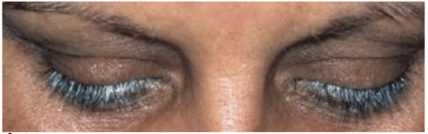 <p>What eyelash condition is this?</p>