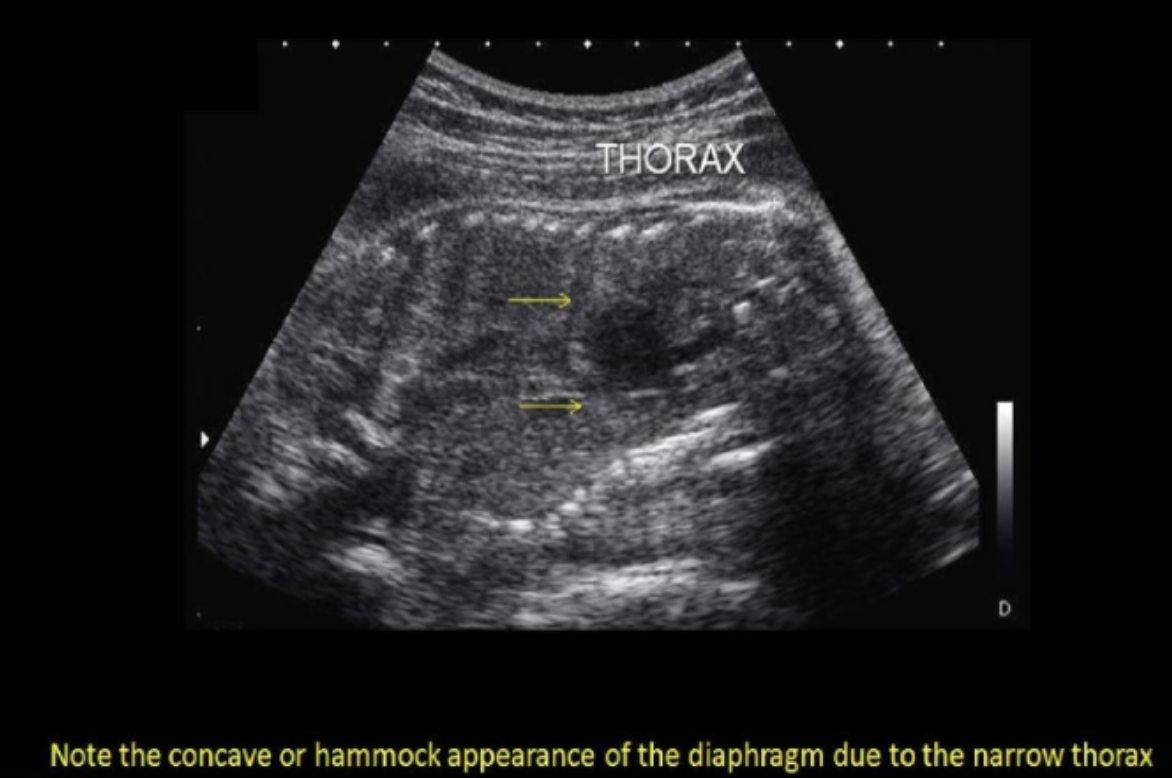 <p>if the radiologist suspects<strong> potter syndrome</strong> + requests that you perform a thoracic circumference. how will this measurement assist in the dx? Potter syndrome usually shows</p><p>.</p><p>a) cardiomegaly + diaphragmatic hernia, which will increase the size of thoracic cavity</p><p>b) pulmonary hyperplasia, which leads to enlarged thorax</p><p>c) a narrow thorax due to acardia</p><p>d) a bell-shaped thorax that is much more narrow than the abd cavity</p>