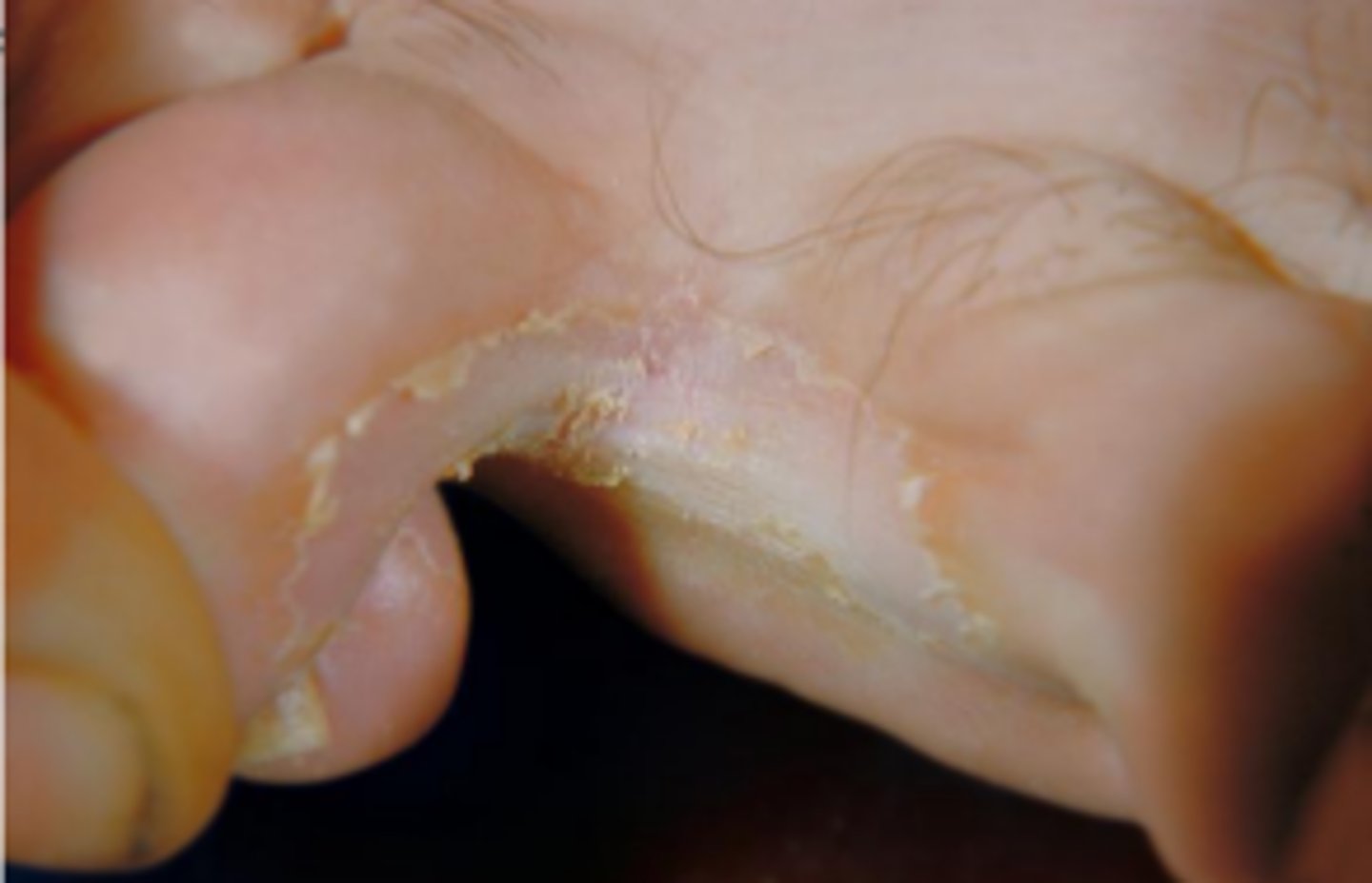 <p>diagnose this image:</p><p>erythematous annular patch w/ distinct border and central clearing ("Serpiginous border"--> undulating border, snake-like)</p>