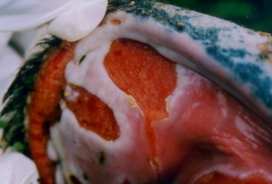 <p>Pemphigus Vulgaris (PV)</p>