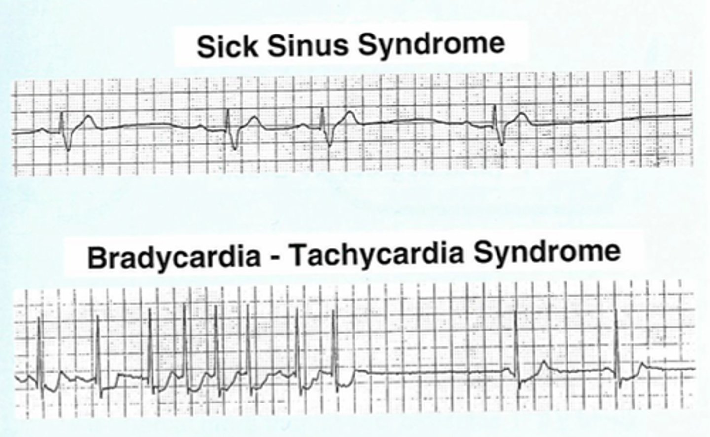 <p>Sinus Node Dysfunction (Sick Sinus Syndrome)Bradycardia-tachycardia syndrome</p>