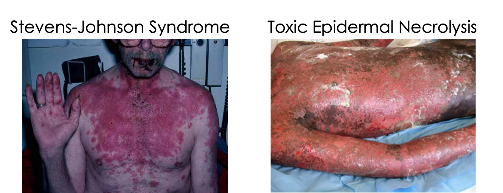 <p>prominent involvement in at least 2-3 mucosal sites (oral, anogenital, conjunctival); encompasses <strong>Steven-johnson syndrome and toxic epidermal necrolysis</strong></p>