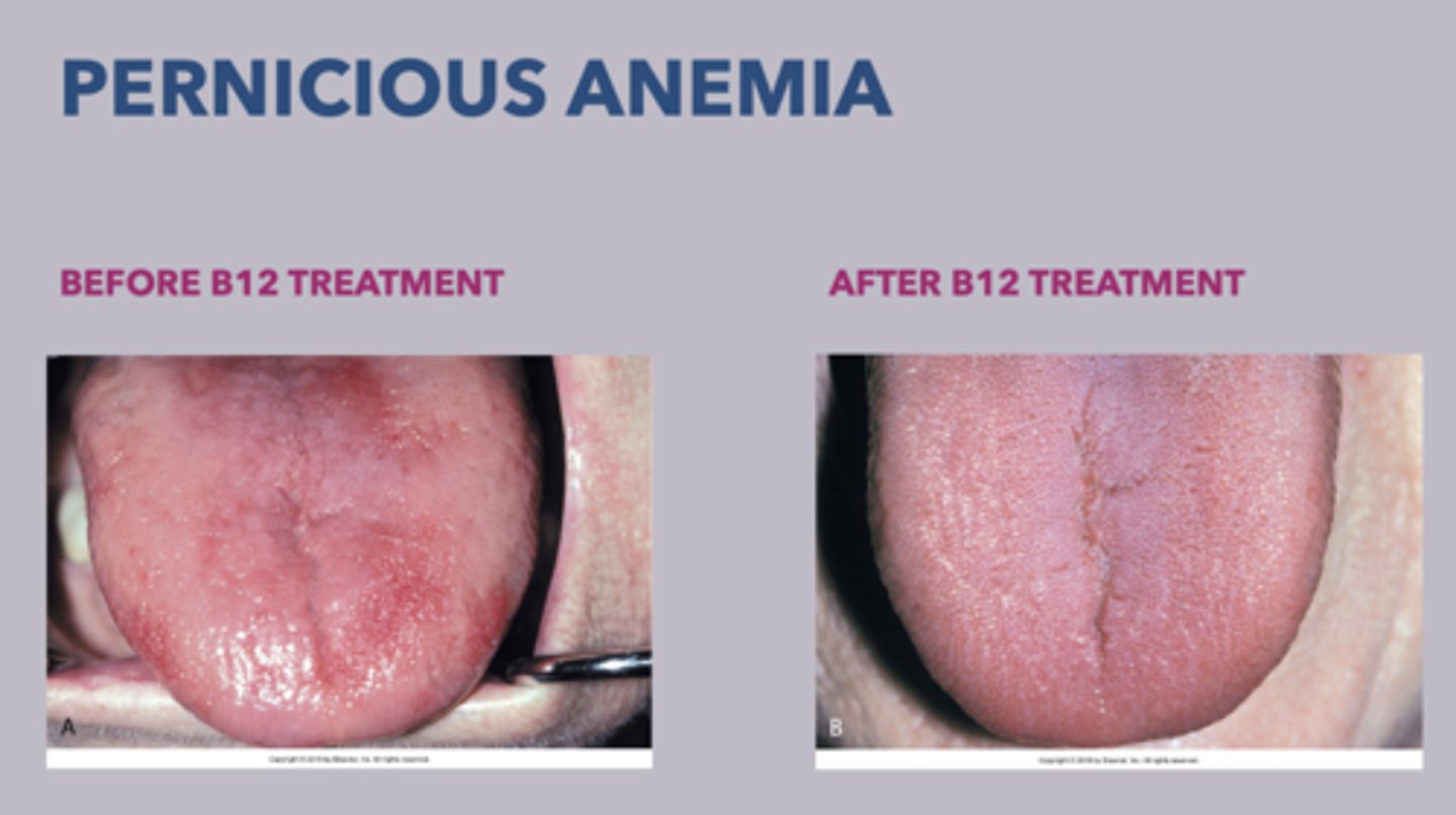 <p>• Intramuscular injections of Vitamin B12</p><p>• High dose of oral Vitamin B12</p>