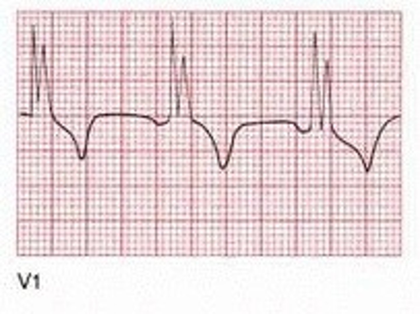 <p>Delay in conduction to either bundle branch causes delay in depolarization of the ventricle it supplies (one ventricle will depolarize before the other); two joined QRS complexes</p>